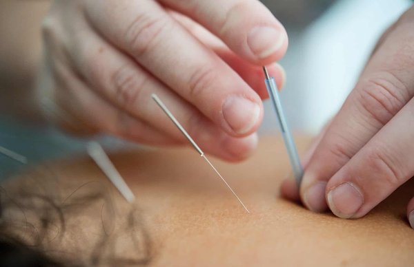 Les avantages de l'acupuncture pour la santé